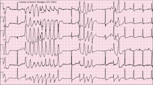 Torsades_de_Pointes_TdP